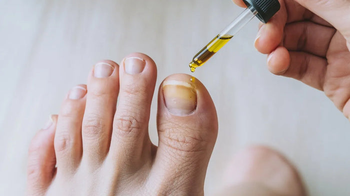 CBD Öl gegen Nagelpilz – Vorteile und Anwendung