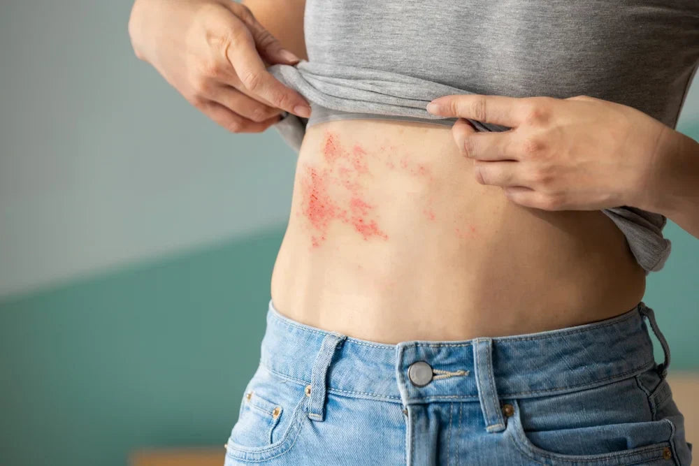 Wie CBD gegen Gürtelrose und Post-Zoster-Neuralgie hilft