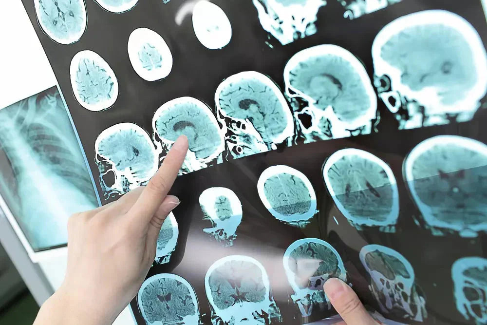 9 positive Wirkungen von CBD Öl bei Multipler Sklerose